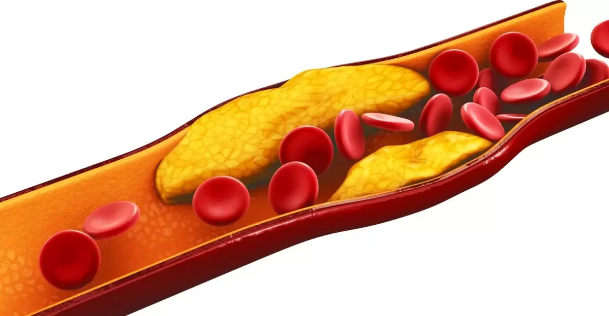 The reason for taking MiCardium capsules is atherosclerosis of vessels